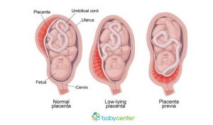 Plasenta previa terjadi ketika jalan lahir bayi tertutup plasenta. 