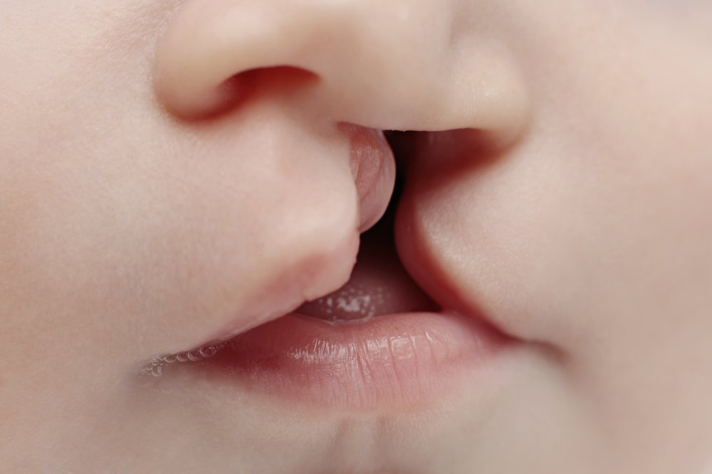 bibir sumbing